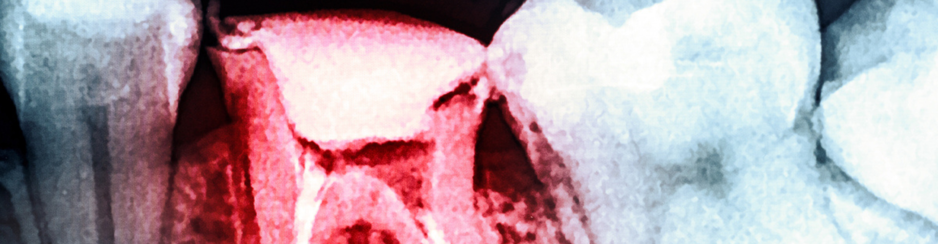 Dental X-ray showing tooth decay.